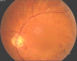 imagini dezlipirea de retina